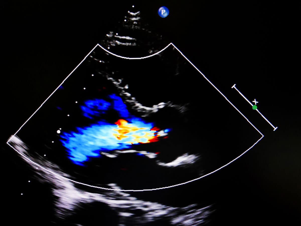 CARDIÓLOGO EN VIGO con Ecocardiograma Doppler en Color