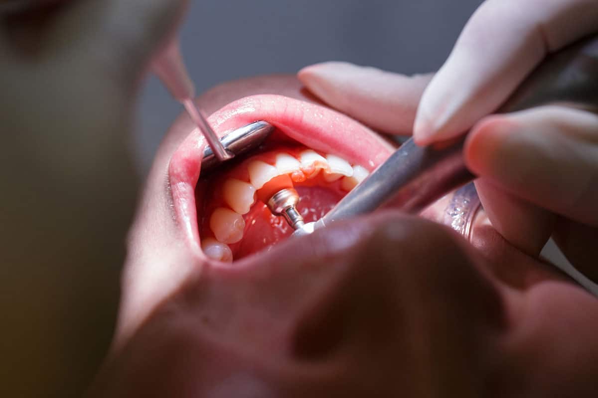 Limpieza dental profunda en vigo