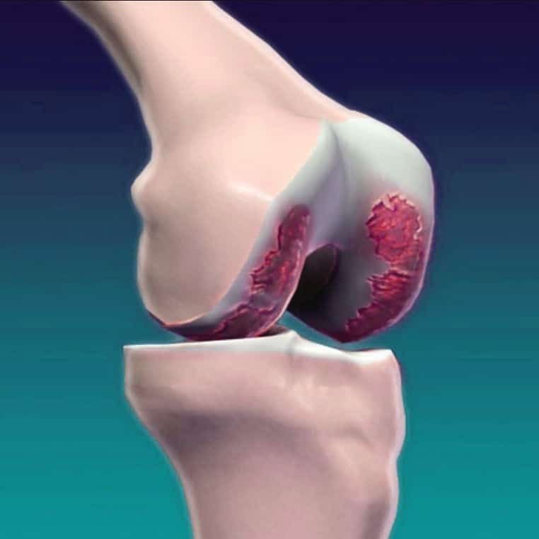 tratamiento de la artrosis en vigo