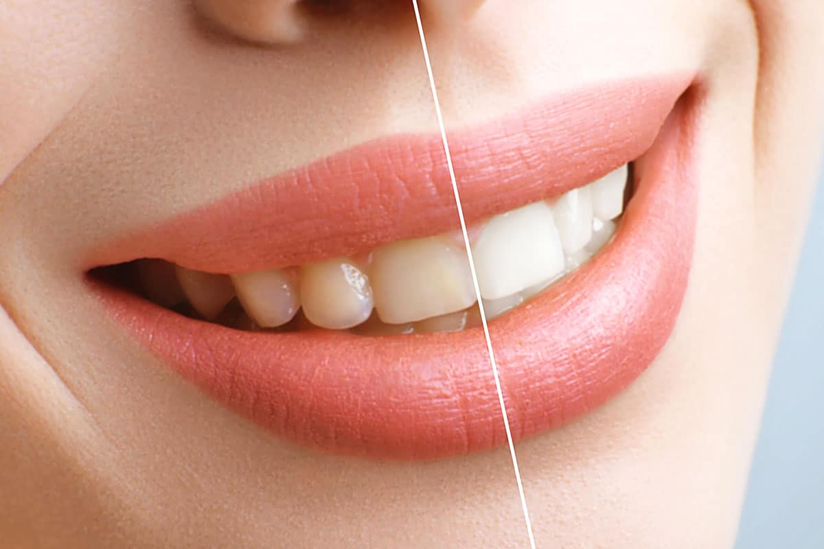 tratamiento de blanqueamiento dental